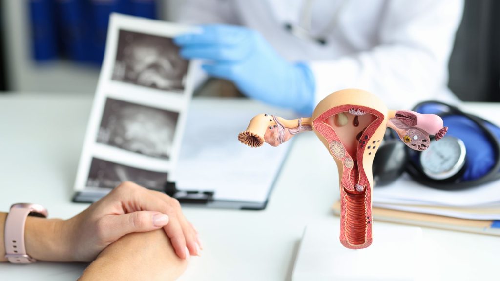 Quistes Ováricos: Criterios para la intervención quirúrgica