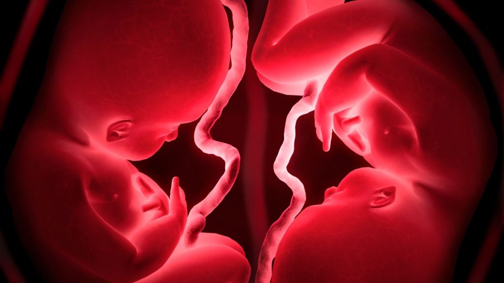 Embarazo gemelar ¿Síndrome de transfusión feto fetal asociado?